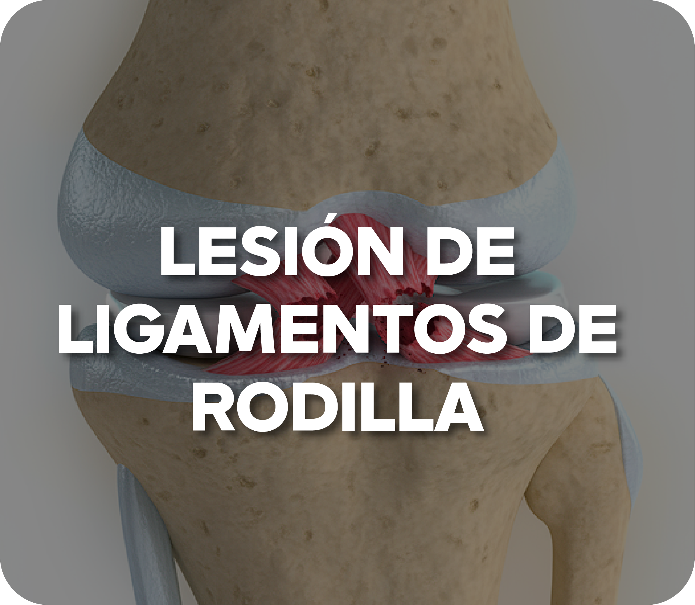 Luxación de hombro